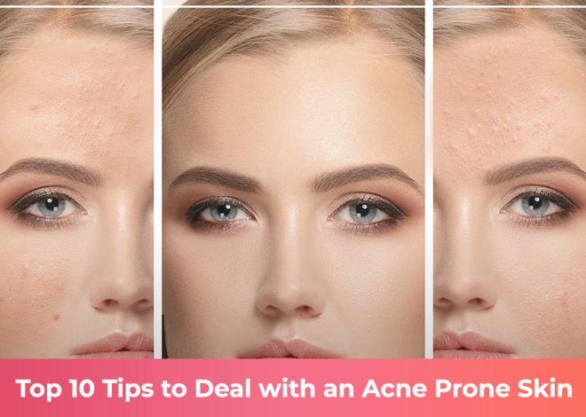 Top 10 Tips to Deal with An Acne Prone Skin