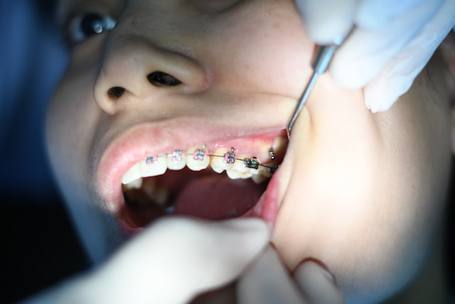 Building Confidence: Affordable Options For Teeth Alignment