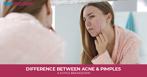 Difference Between Acne and Pimples: A Simple Breakdown