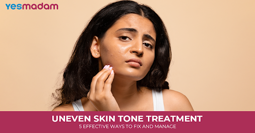 Uneven Skin Tone Treatment: 5 Effective Ways to Fix and Manage