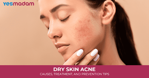 Dry Skin Acne: Causes, Treatment, and Prevention Tips