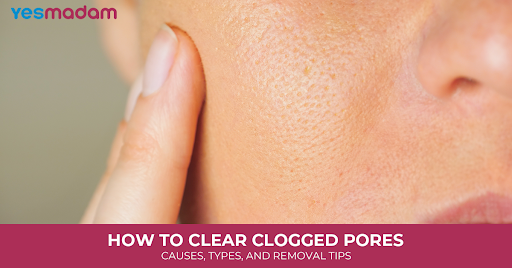 How To Clear Clogged Pores: Causes, Types, and Removal Tips