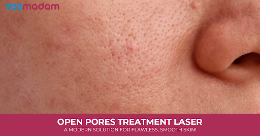 Open Pores Treatment Laser: A Modern Solution for Flawless, Smooth Skin!
