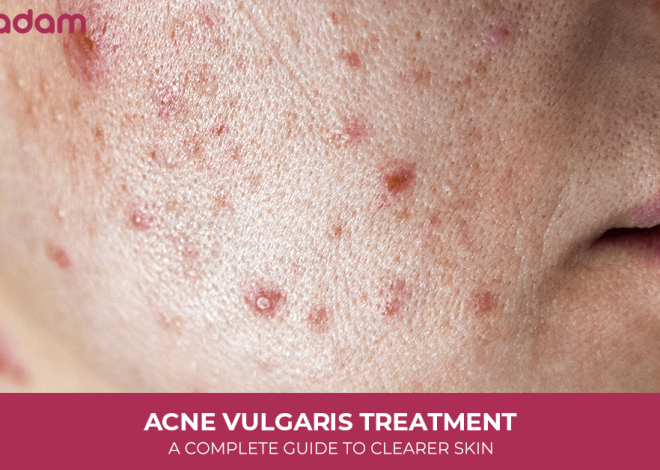 Acne Vulgaris Treatment: A Complete Guide to Clearer Skin