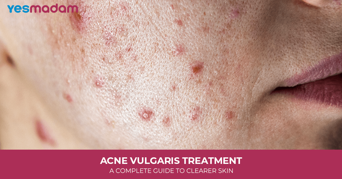 Acne Vulgaris Treatment: A Complete Guide to Clearer Skin