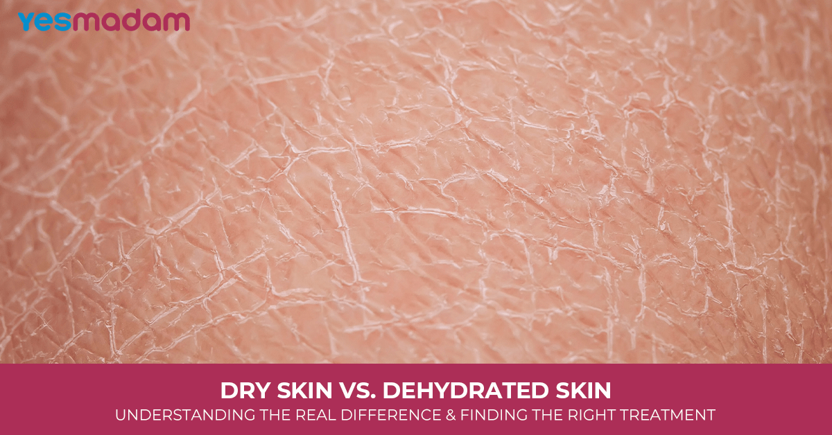 Dry Skin vs. Dehydrated Skin: Understanding the Real Difference and Finding the Right Treatment