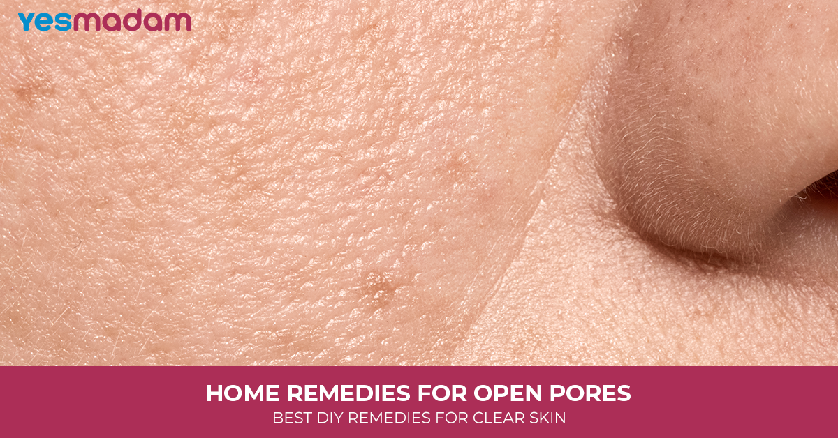Home Remedies for Open Pores: Best DIY Remedies for Clear Skin