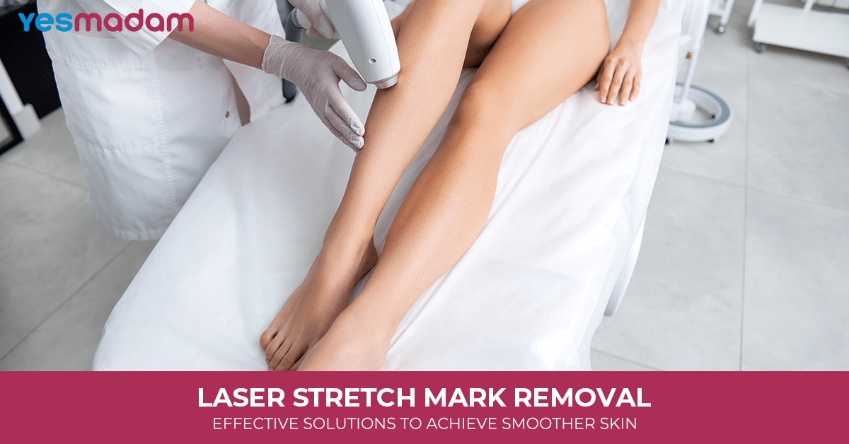 Laser Stretch Mark Removal: Effective Solutions to Achieve Smoother Skin