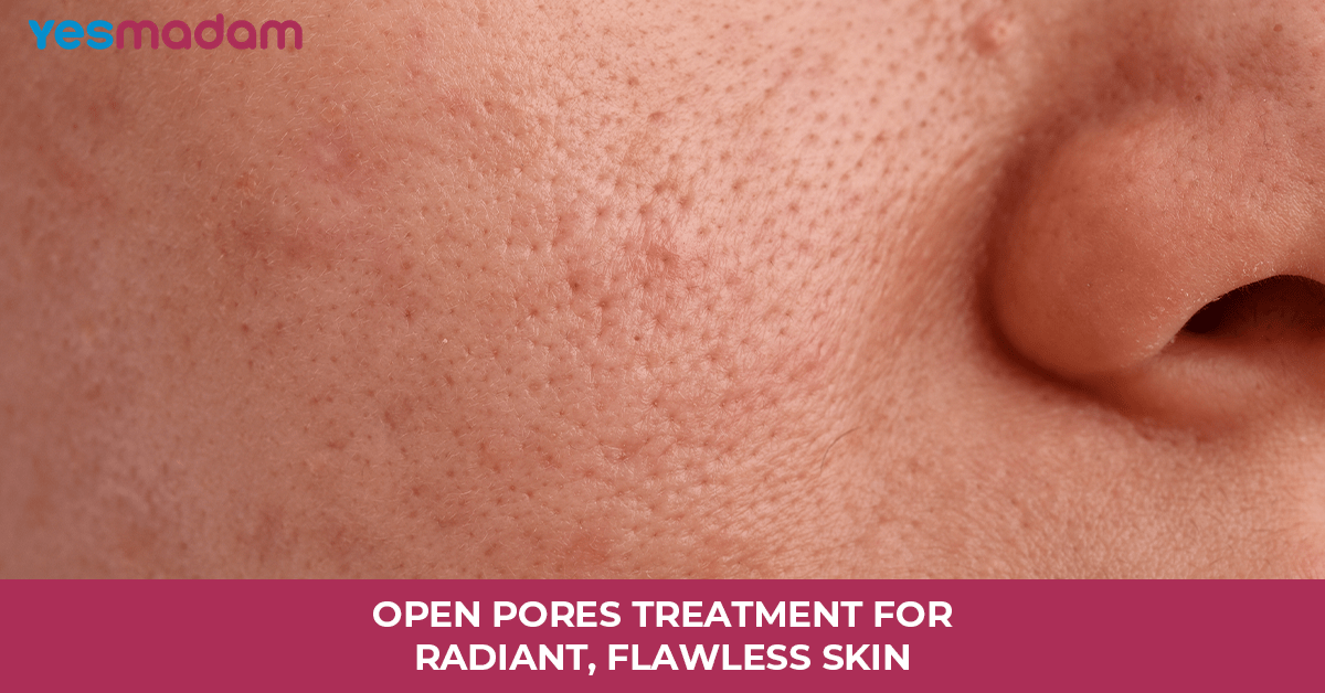 Open Pores Treatment for Radiant, Flawless Skin