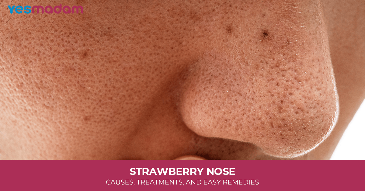 Strawberry Nose: Causes, Treatments, and Easy Remedies