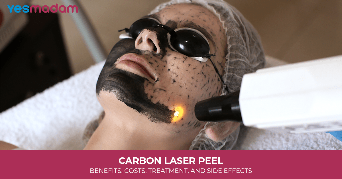 Carbon Laser Peel: Benefits, Costs, Treatment, and Side Effects