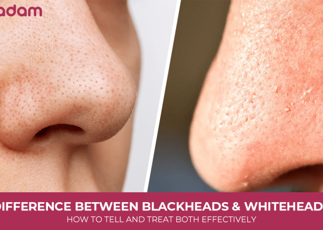 Difference Between Blackheads and Whiteheads: How To Tell and Treat Both Effectively