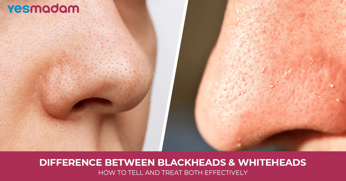 Difference Between Blackheads and Whiteheads: How To Tell and Treat Both Effectively