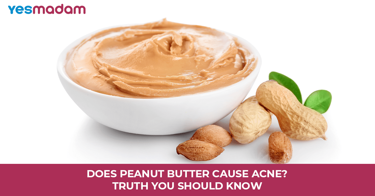 Does Peanut Butter Cause Acne? Truth You Should Know