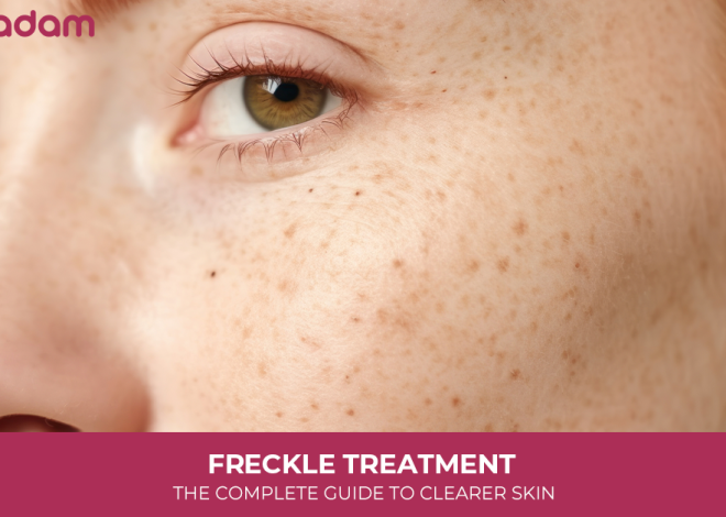 Freckle Treatment: The Complete Guide to Clearer Skin