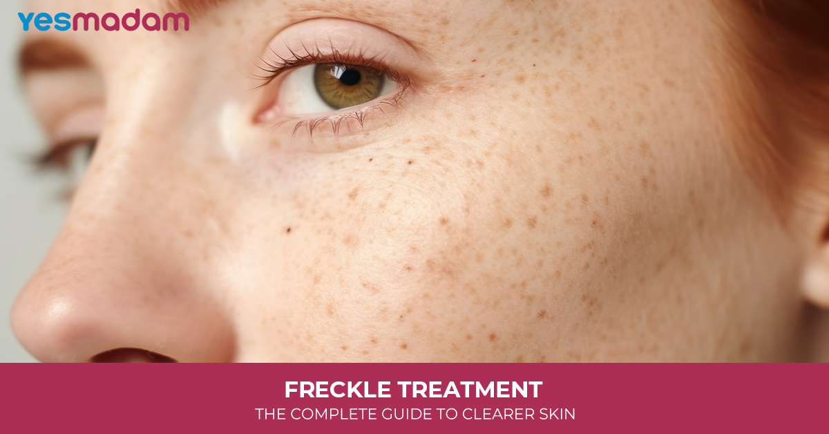 Freckle Treatment: The Complete Guide to Clearer Skin