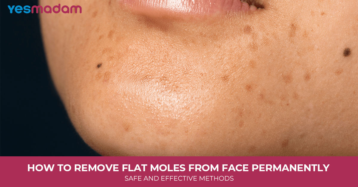 How to Remove Flat Moles From Face Permanently: Safe and Effective Methods