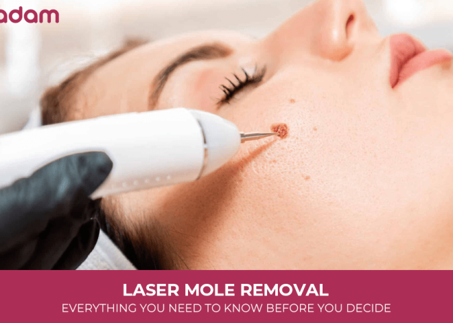 Laser Mole Removal: Everything You Need to Know Before You Decide