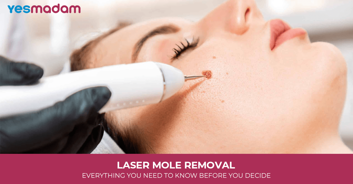 Laser Mole Removal: Everything You Need to Know Before You Decide