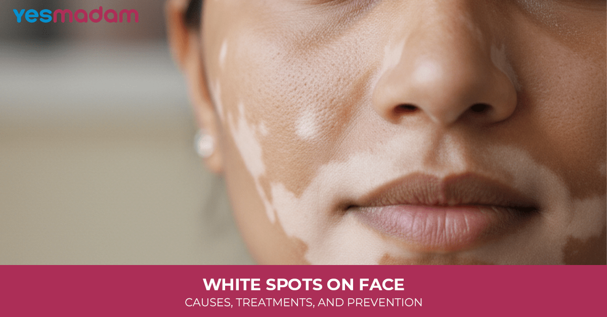 White Spots on Face: Causes, Treatments, and Prevention