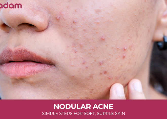 Nodular Acne: Causes, Treatment Options, and How to Heal Without Scars