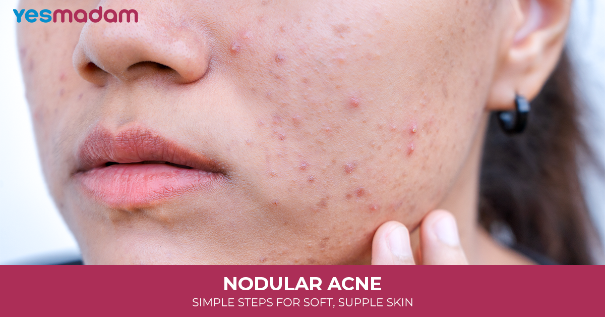 Nodular Acne: Causes, Treatment Options, and How to Heal Without Scars