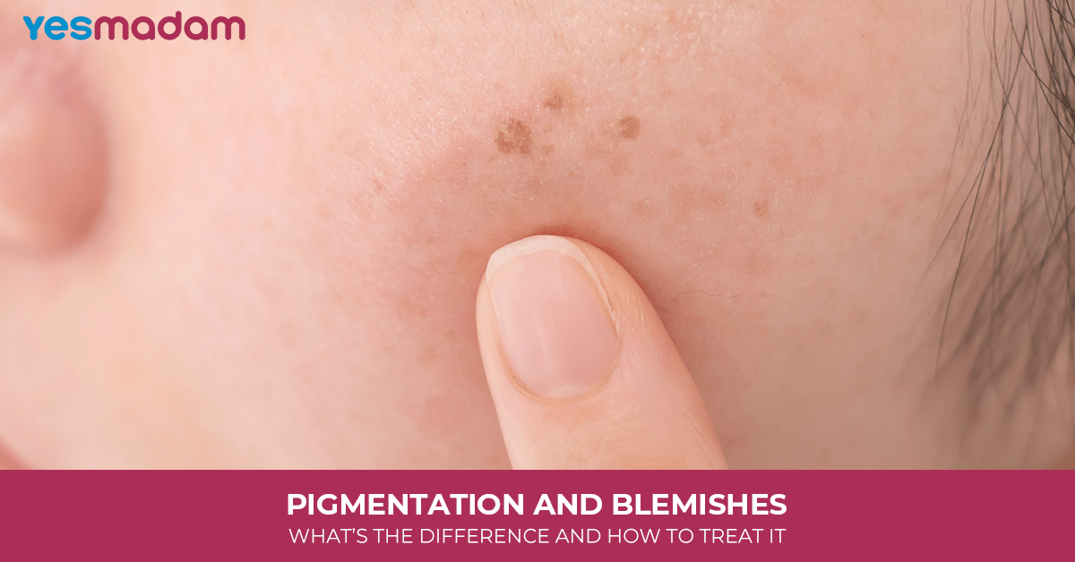 Pigmentation And Blemishes: What’s The Difference And How To Treat It