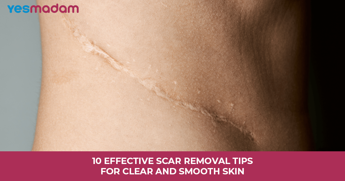10 Effective Scar Removal Tips For Clear And Smooth Skin