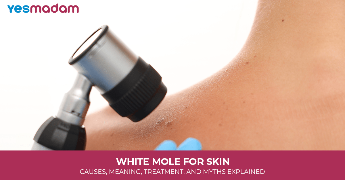 White Mole for Skin: Causes, Meaning, Treatment, and Myths Explained