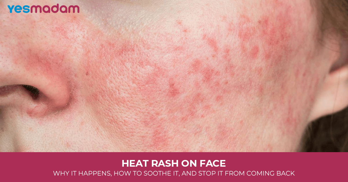 Heat Rash on Face: Why It Happens, How to Soothe It, and Stop It From Coming Back
