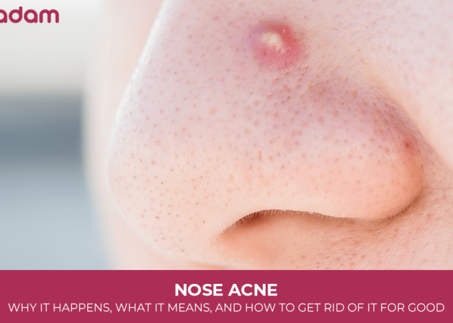 Nose Acne: Why It Happens, What It Means, and How to Get Rid of It for Good
