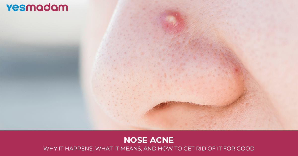 Nose Acne: Why It Happens, What It Means, and How to Get Rid of It for Good