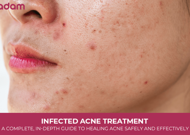Infected Acne Treatment: A Complete, In-Depth Guide to Healing Acne Safely and Effectively