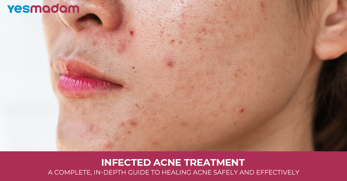 Infected Acne Treatment: A Complete, In-Depth Guide to Healing Acne Safely and Effectively