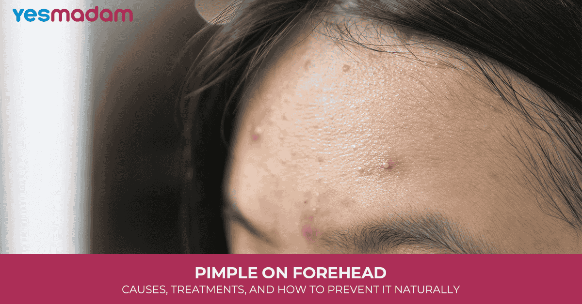Pimple on Forehead: Causes, Treatments, and How to Prevent It Naturally